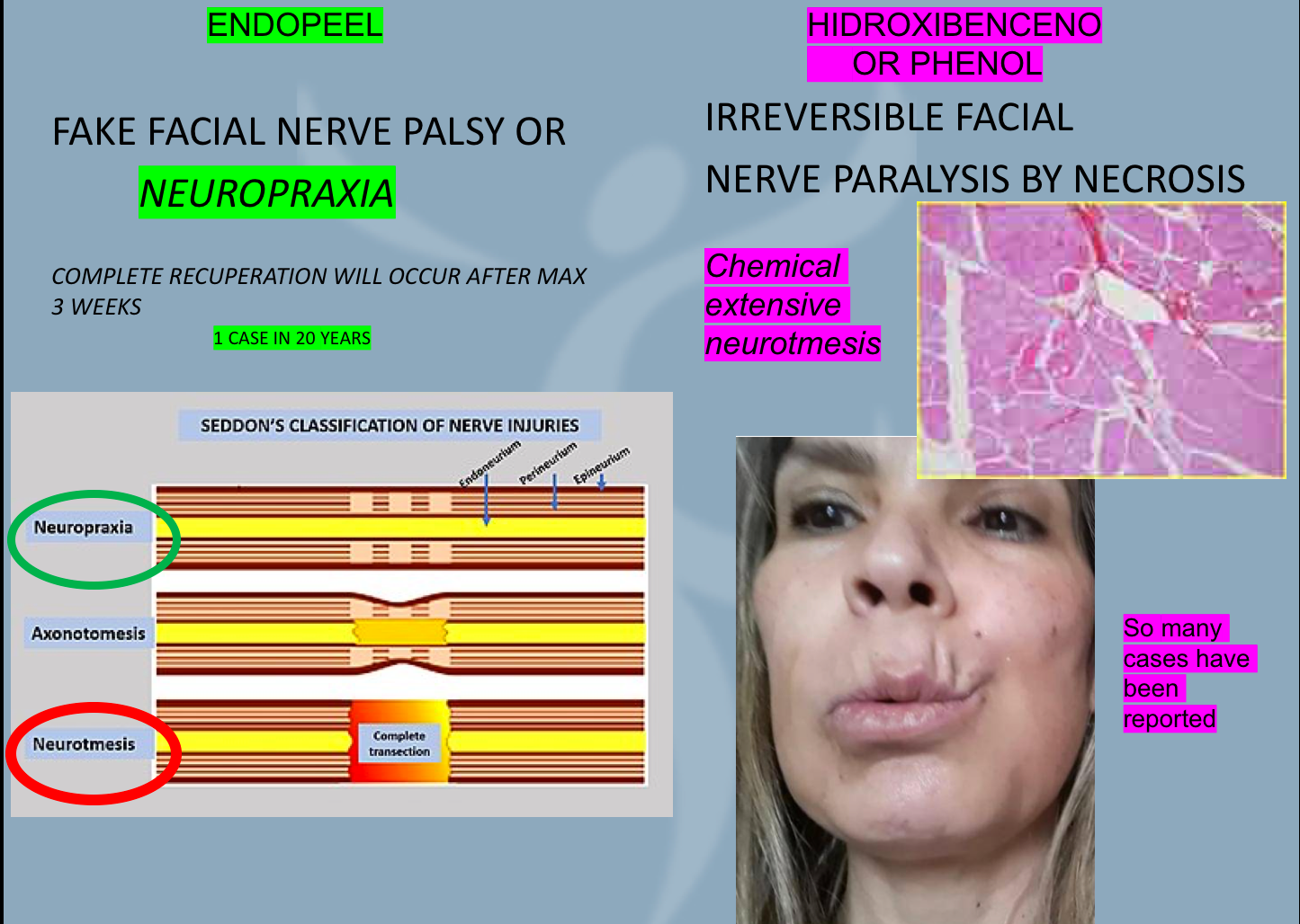 neuropraxia vs neurotmesis