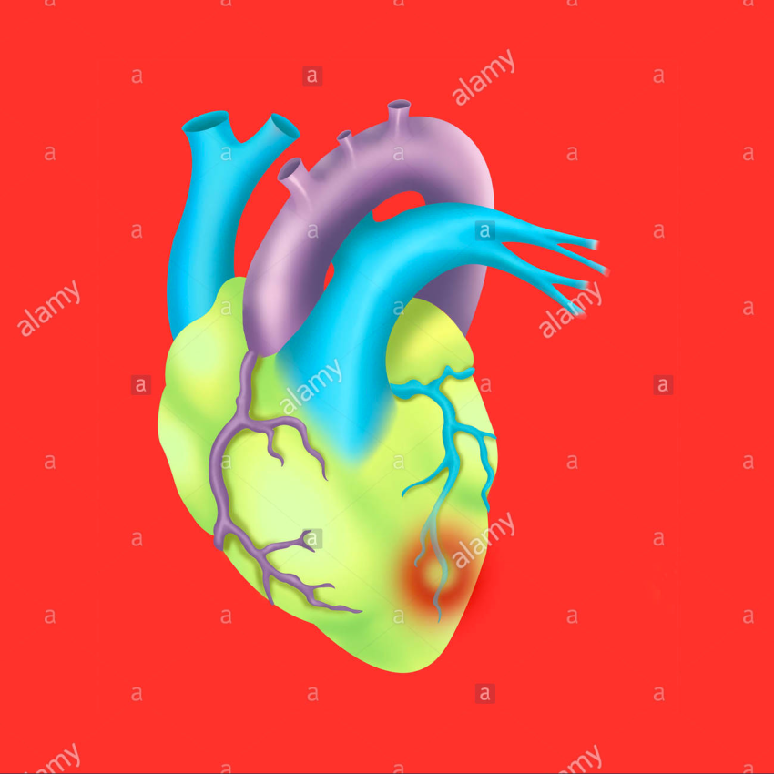 cardiac insufficiency