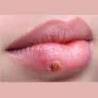 herpes labialis