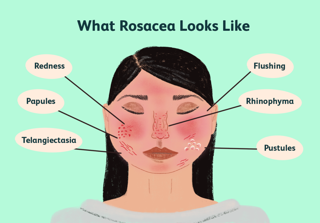 rosacea overview