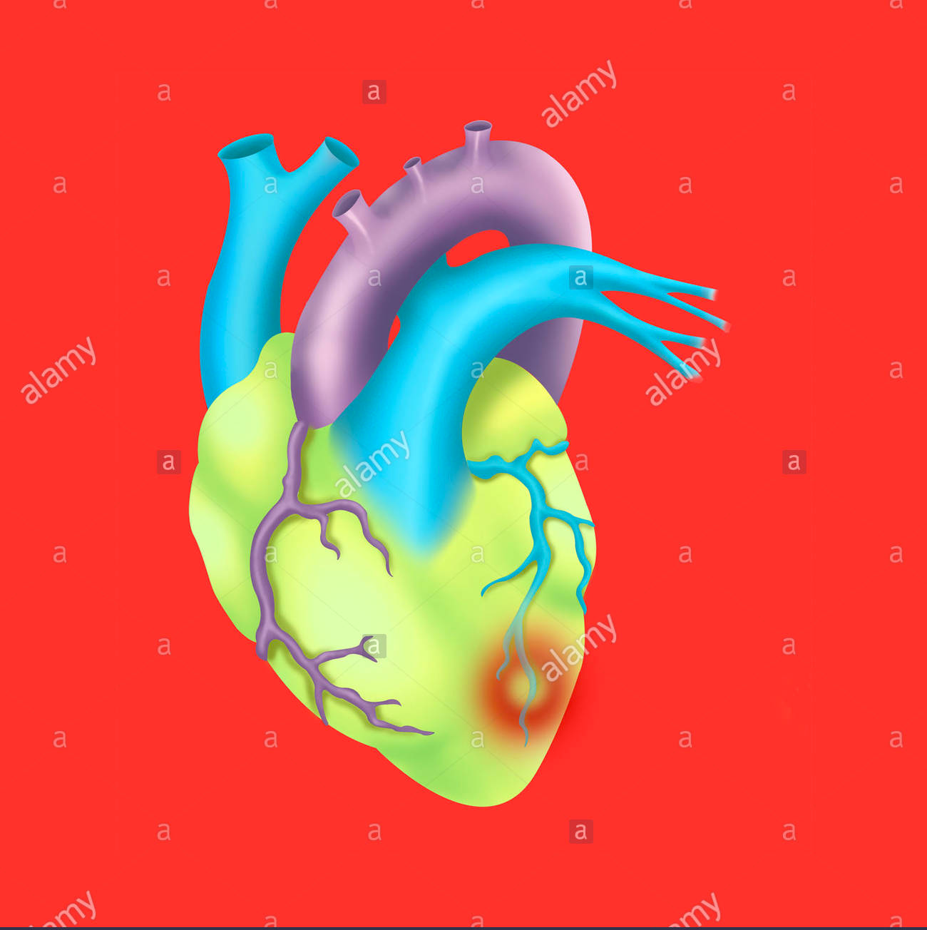 cardiac insufficiency