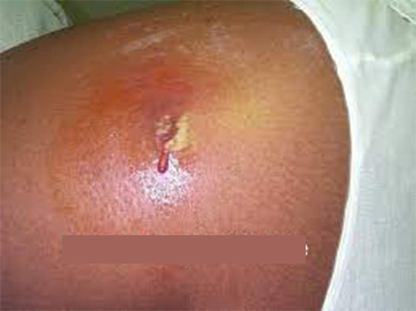 infection injection site