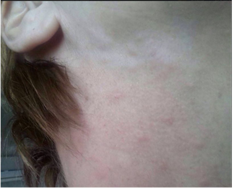 arachis perfume allergy