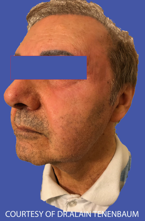 Monolateral Left Cheek Edema without Treatment
