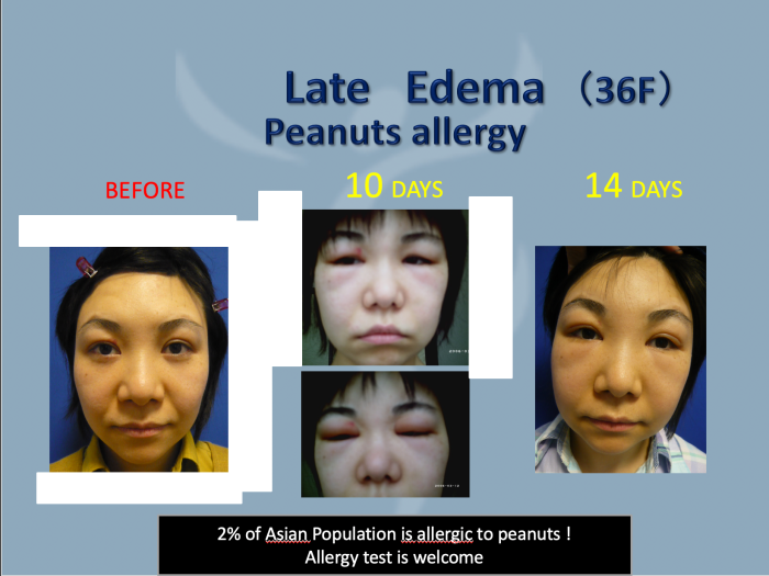 late edema peanut allergy