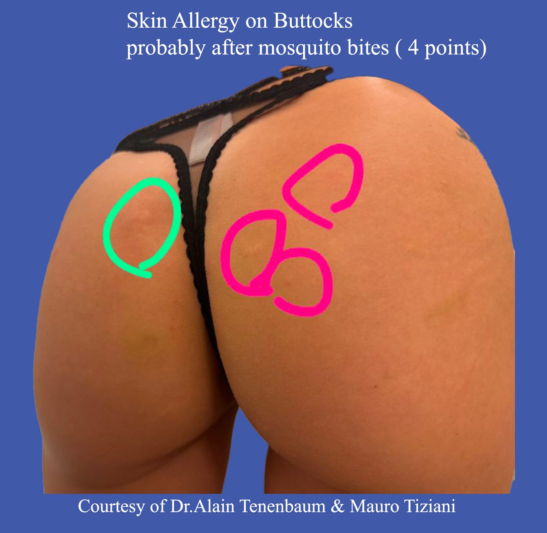 skin-allergy-butts